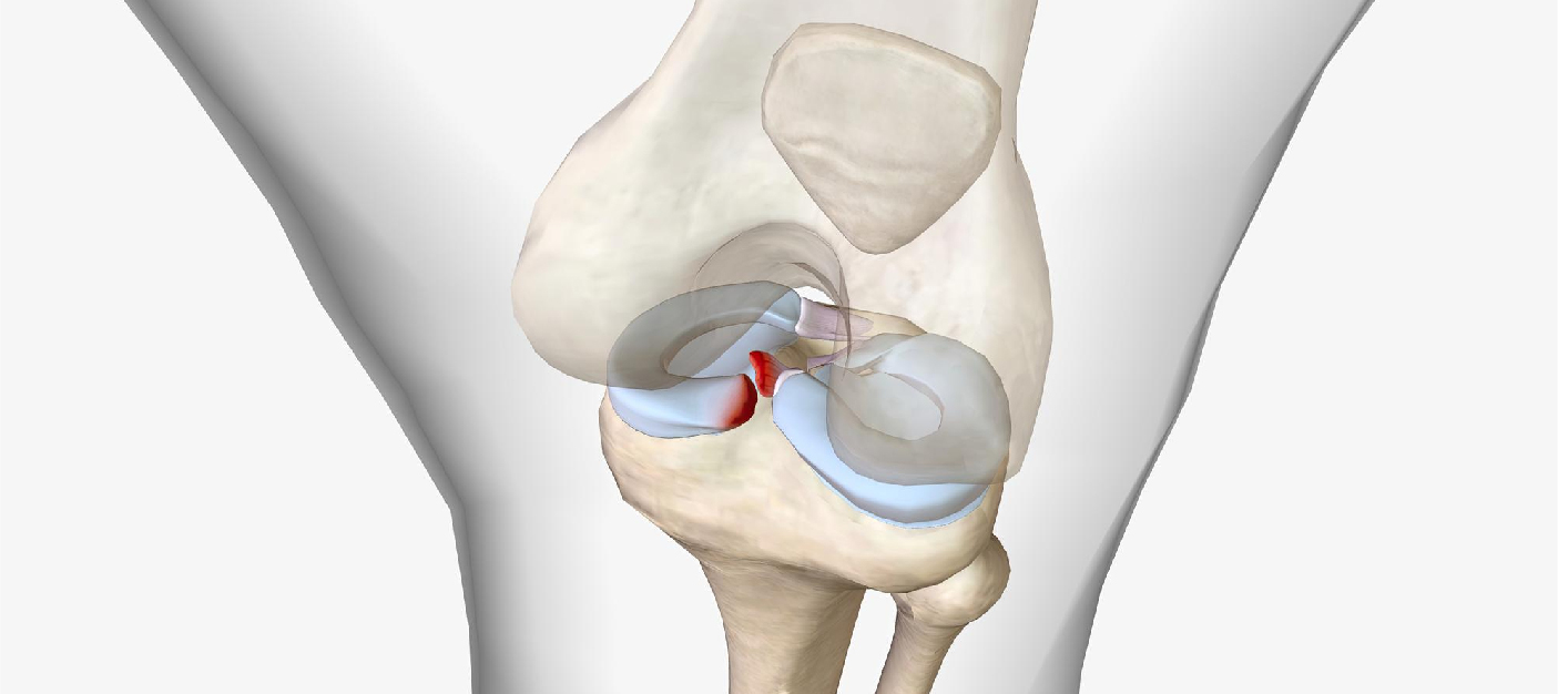 Robotic Partial Knee Replacement : A Brief Introduction